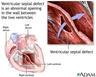 imagine cu defectul septal